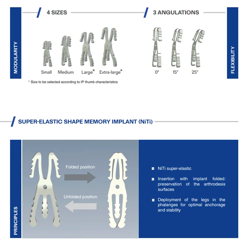 KeriFuse Intramedullary Arthodesis Implant (DIP/IP 0°/15°/25°)